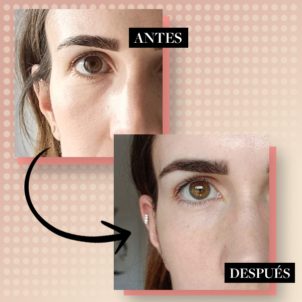 Antes y después aparato radiofrecuencia facial