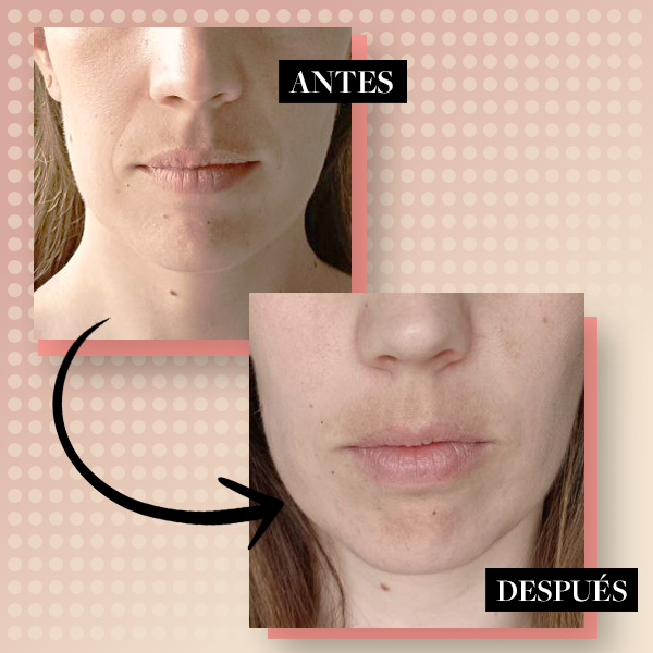 Antes y después aparato radiofrecuencia facial